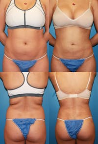 Liposuction: Female Before & After Gallery - Patient 2394709 - Image 1