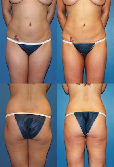 Liposuction: Female Before & After Gallery - Patient 2394710 - Image 1