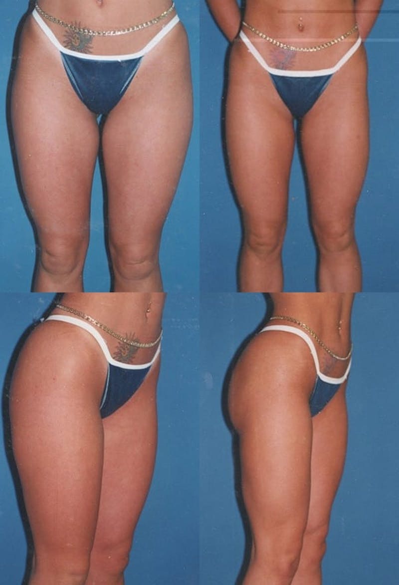 Liposuction: Female Before & After Gallery - Patient 2394711 - Image 1