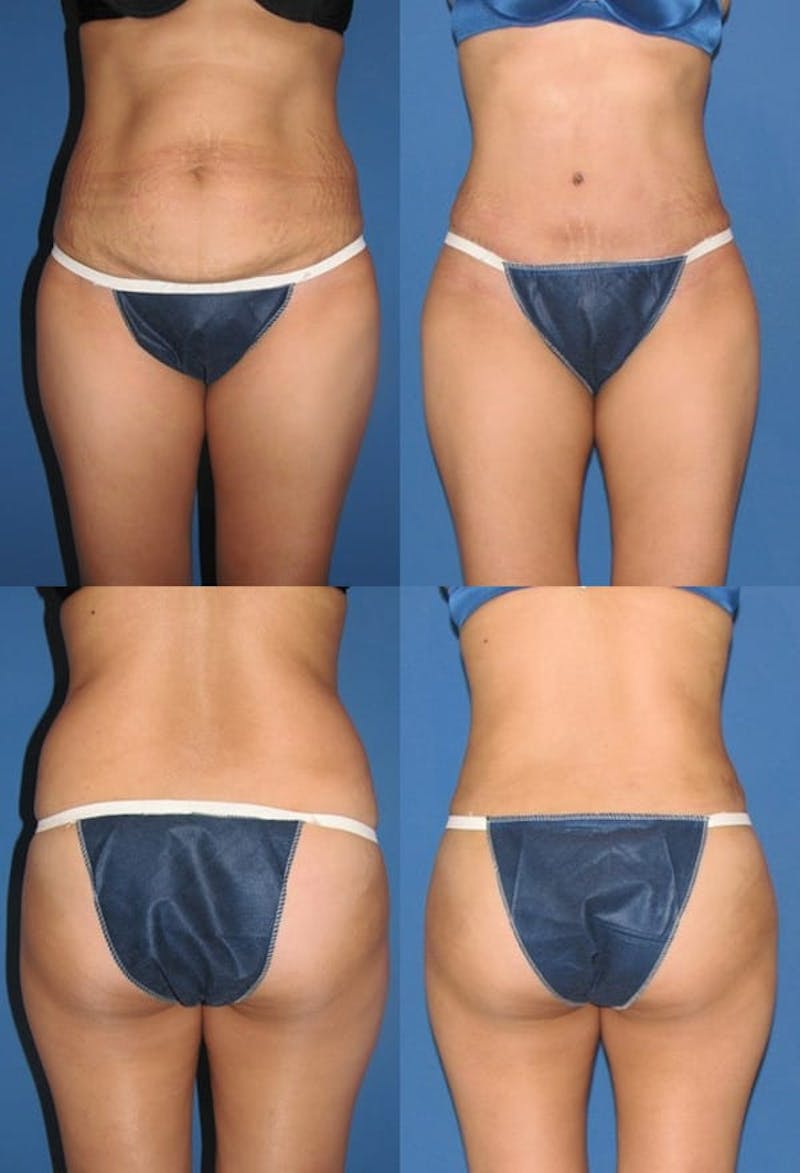 Liposuction Before & After Gallery - Patient 2158956 - Image 1