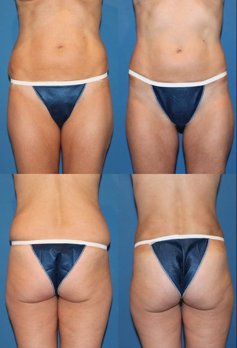 Liposuction Before & After Gallery - Patient 2158958 - Image 1