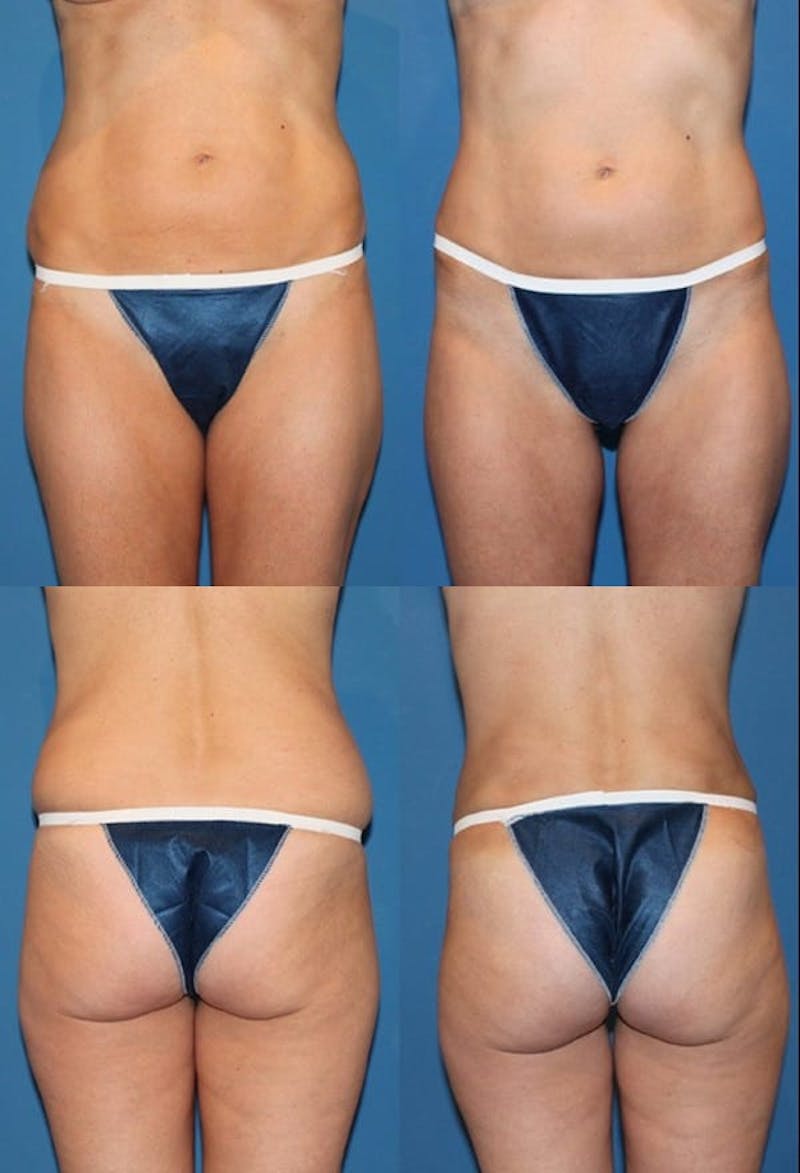 Liposuction: Female Before & After Gallery - Patient 2394713 - Image 1