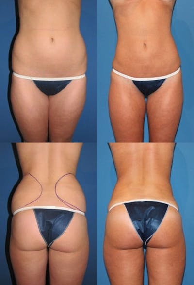 Liposuction Before & After Gallery - Patient 2158960 - Image 1