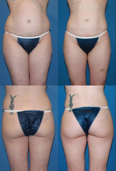 Liposuction Before & After Gallery - Patient 2158961 - Image 1