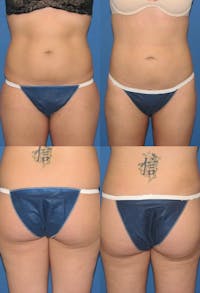 Liposuction: Female Before & After Gallery - Patient 2394716 - Image 1