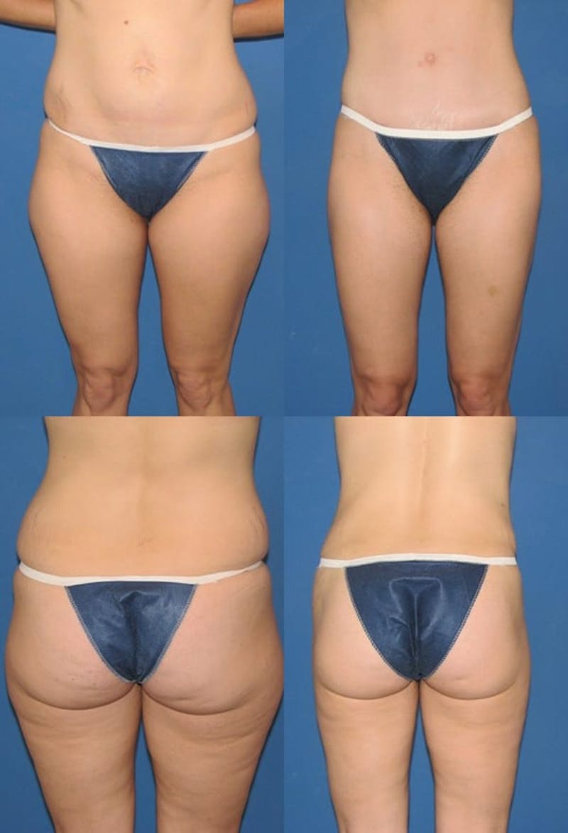 Liposuction Gallery - Patient 2158963 - Image 1