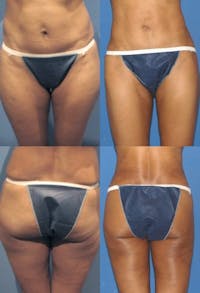 Liposuction: Female Before & After Gallery - Patient 2394718 - Image 1