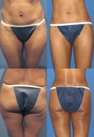 Liposuction: Female Before & After Gallery - Patient 2394718 - Image 1