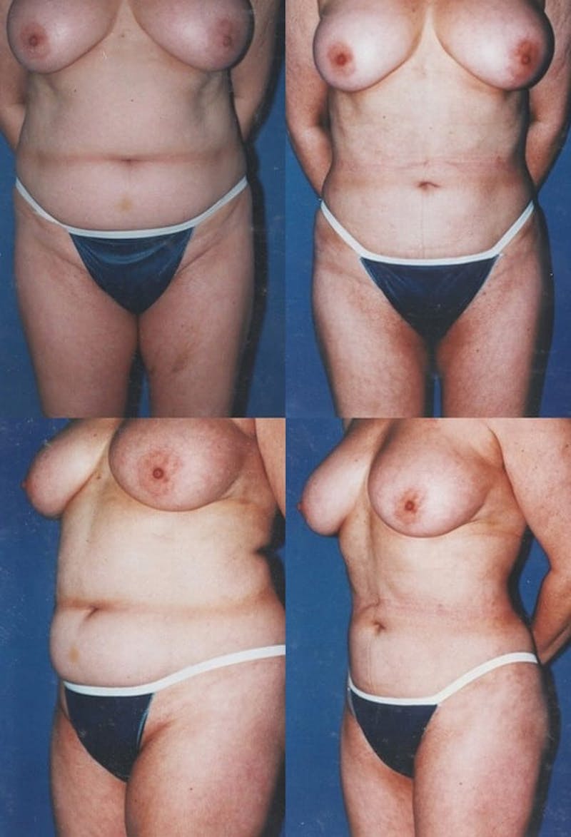 Liposuction Before & After Gallery - Patient 2158966 - Image 1