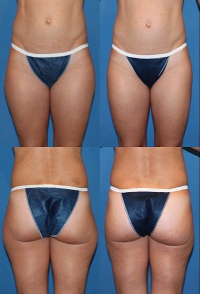 Liposuction: Female Before & After Gallery - Patient 2394720 - Image 1