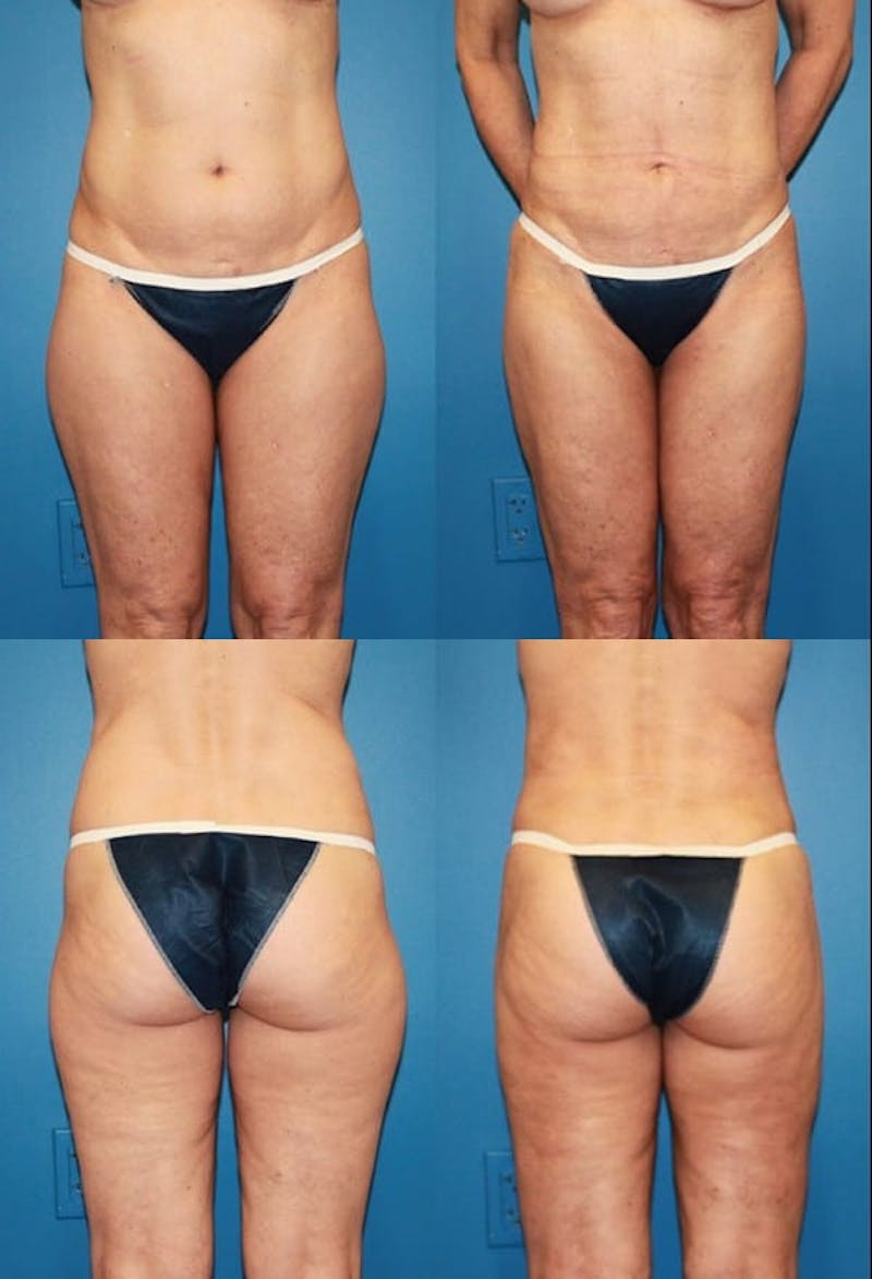 Liposuction: Female Before & After Gallery - Patient 2394722 - Image 1