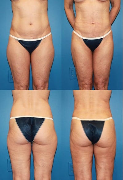 Liposuction Before & After Gallery - Patient 2158969 - Image 1