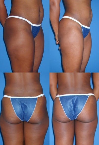 Liposuction: Female Before & After Gallery - Patient 2394723 - Image 1