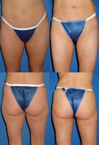 Liposuction Before & After Gallery - Patient 2158972 - Image 1
