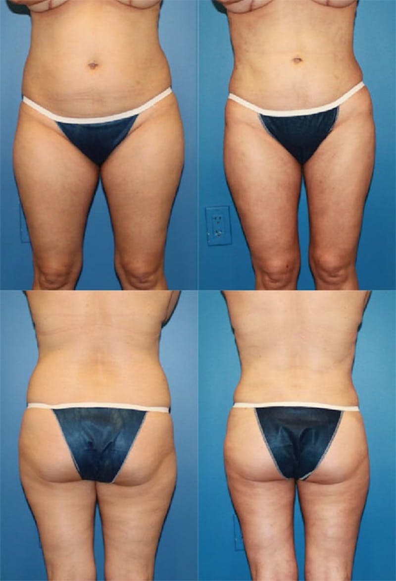Liposuction: Female Before & After Gallery - Patient 2394726 - Image 1