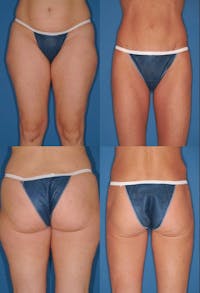Liposuction: Female Before & After Gallery - Patient 2394727 - Image 1