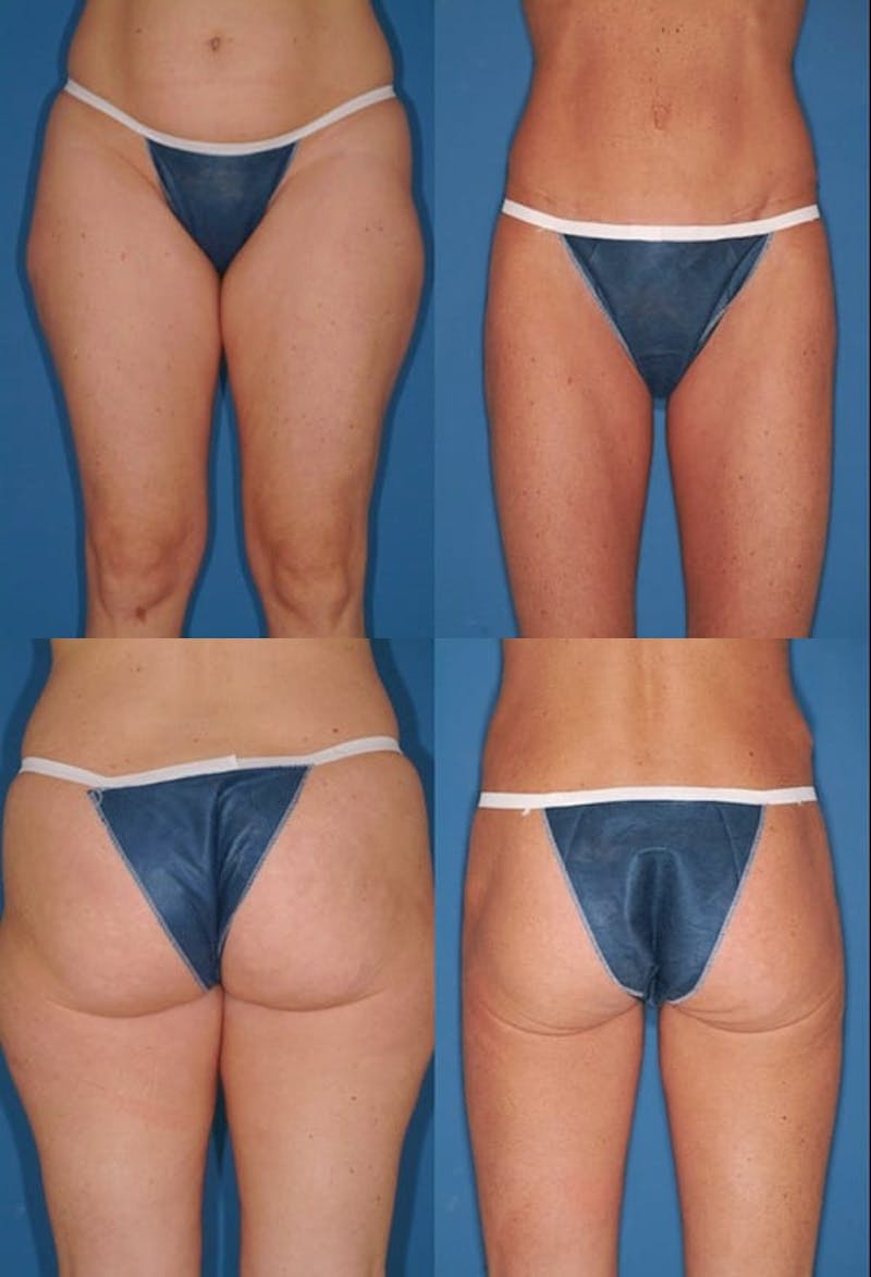 Liposuction: Female Before & After Gallery - Patient 2394727 - Image 1