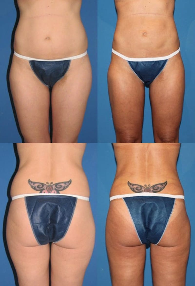 Liposuction Before & After Gallery - Patient 2158986 - Image 1