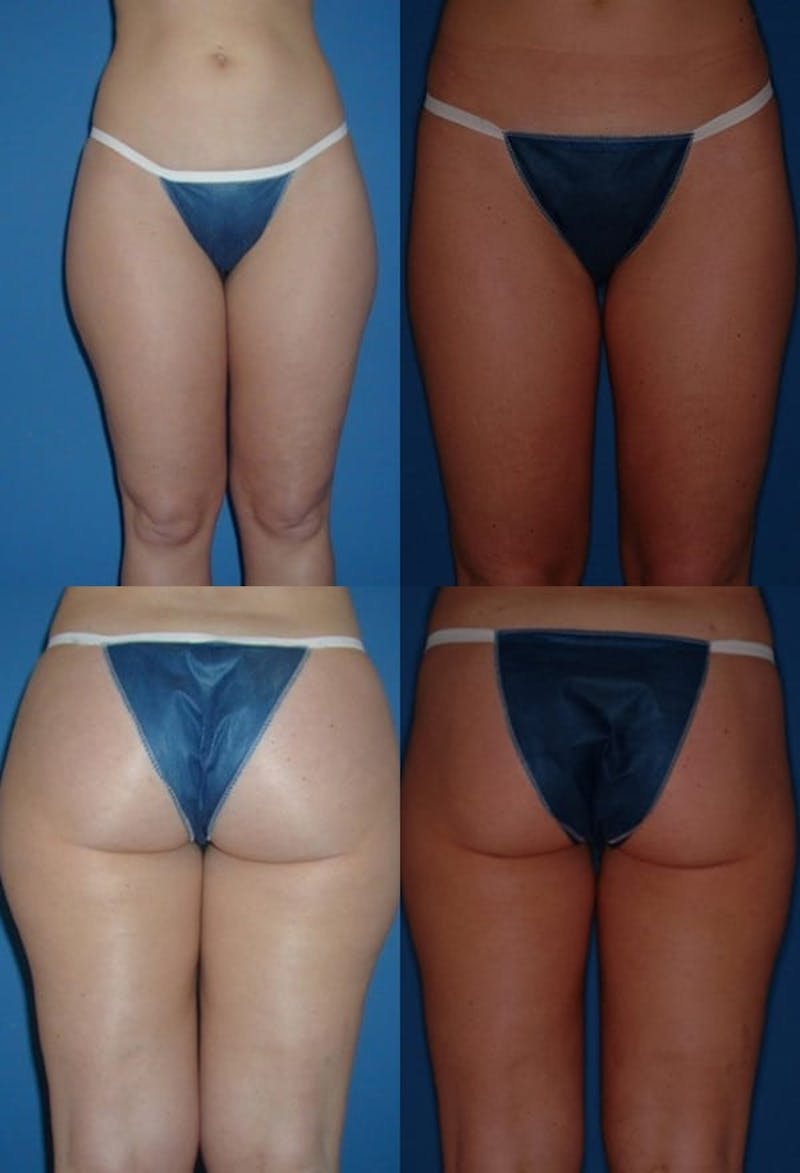 Liposuction Before & After Gallery - Patient 2158989 - Image 1