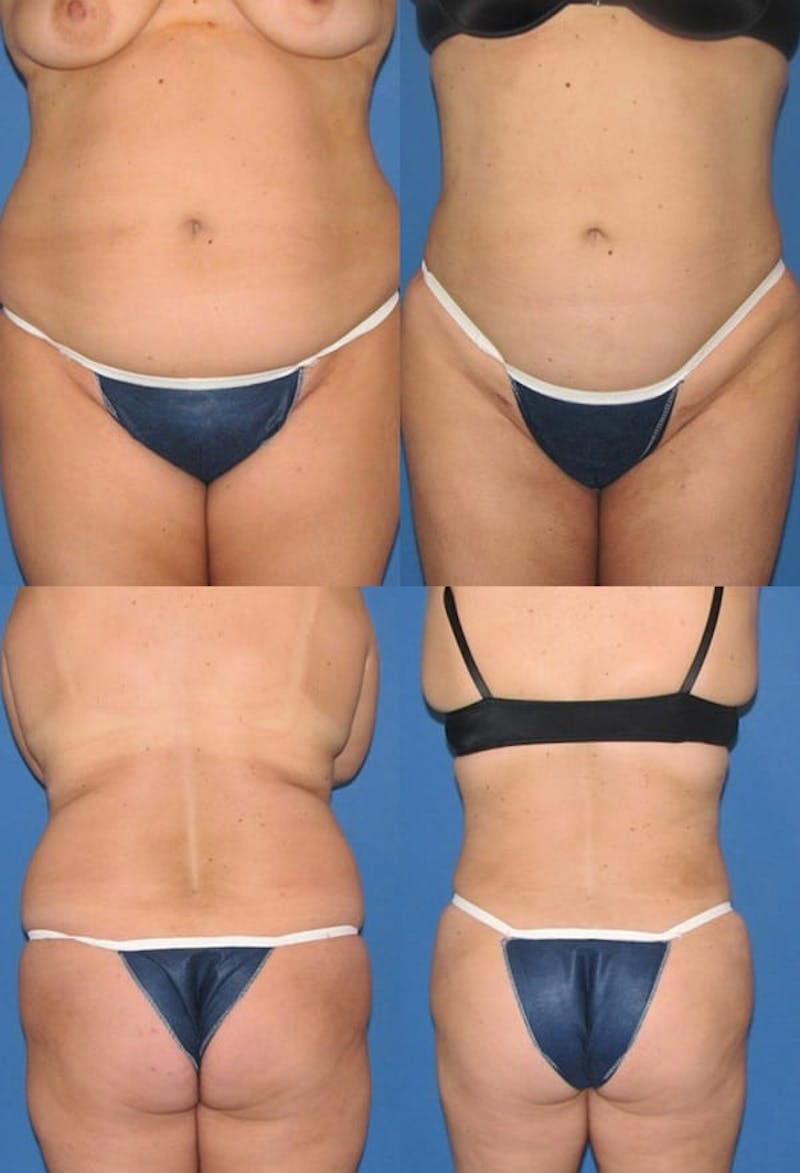 Liposuction Gallery - Patient 2158991 - Image 1