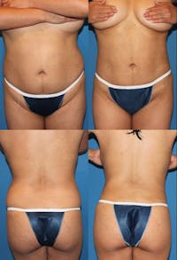Liposuction Before & After Gallery - Patient 2158993 - Image 1