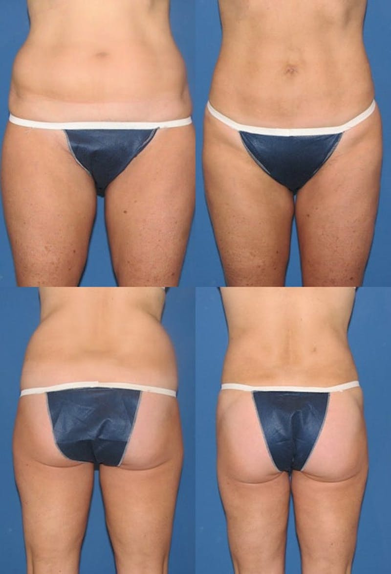 Liposuction: Female Gallery - Patient 2394733 - Image 1