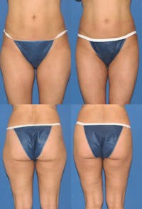 Liposuction: Female Before & After Gallery - Patient 2394735 - Image 1