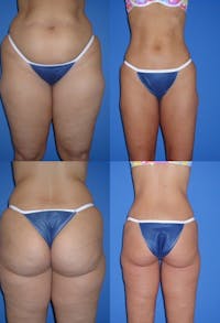 Liposuction: Female Before & After Gallery - Patient 2394736 - Image 1