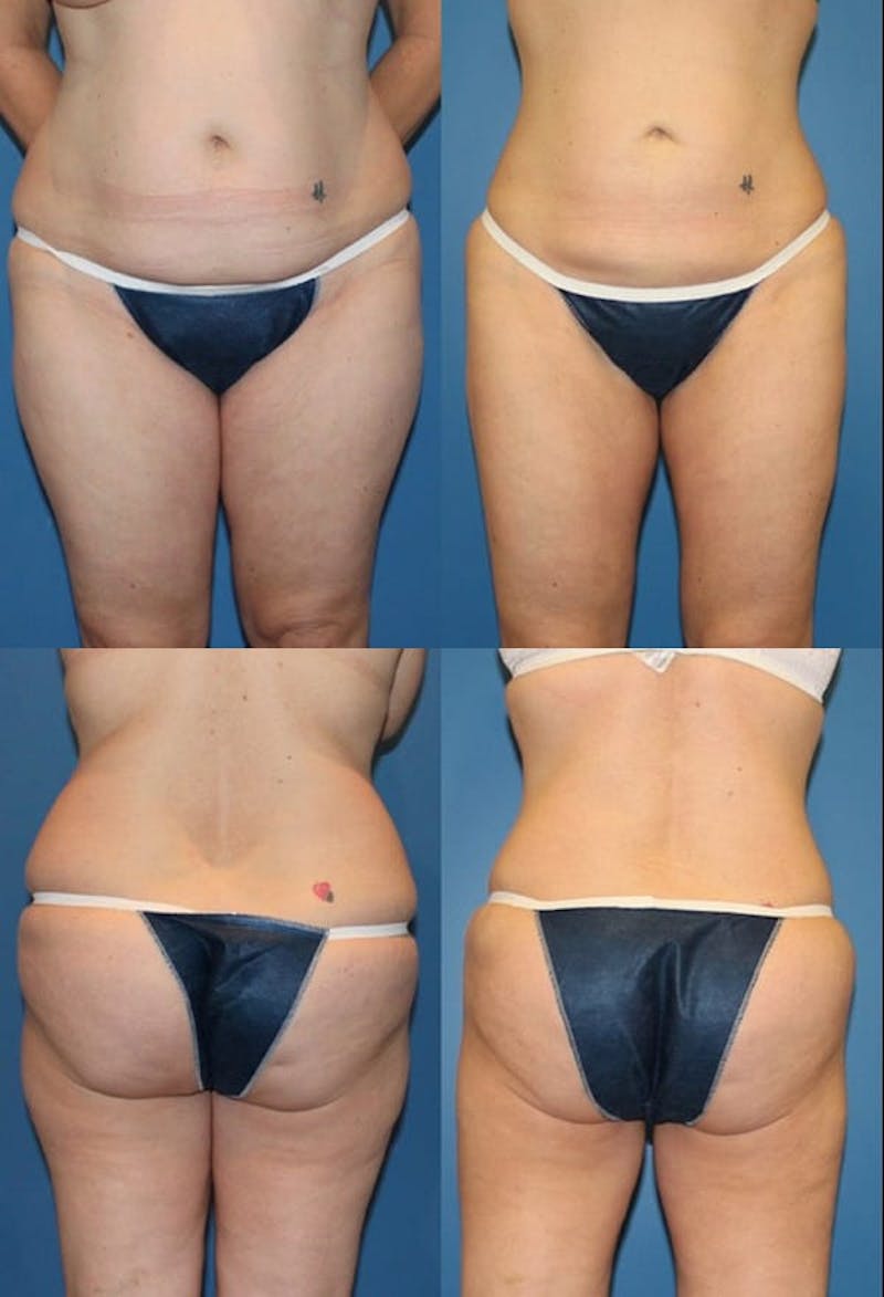 Liposuction: Female Gallery - Patient 2394737 - Image 1