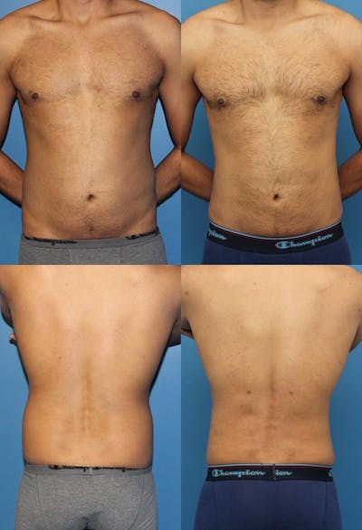 Liposuction Before & After Gallery - Patient 2159002 - Image 1