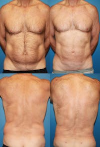 Liposuction Male Before & After Gallery - Patient 2394817 - Image 1