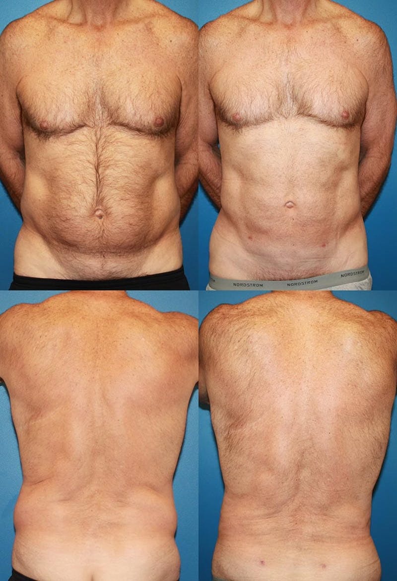 Patient 2394817, Liposuction Before and After