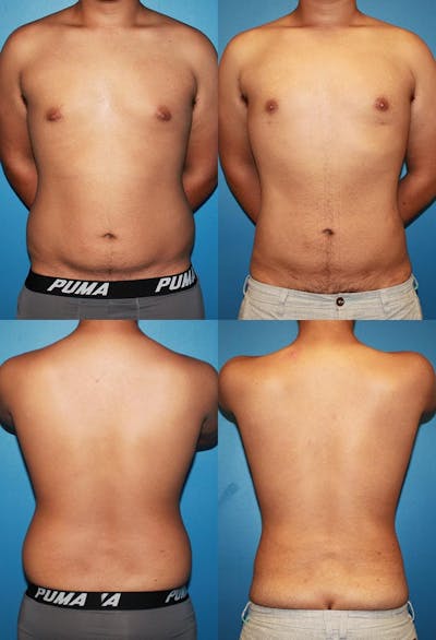 Liposuction Before & After Gallery - Patient 2159006 - Image 1