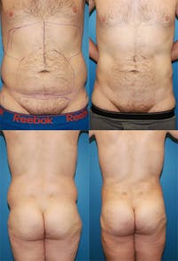 Liposuction Before & After Gallery - Patient 2159008 - Image 1