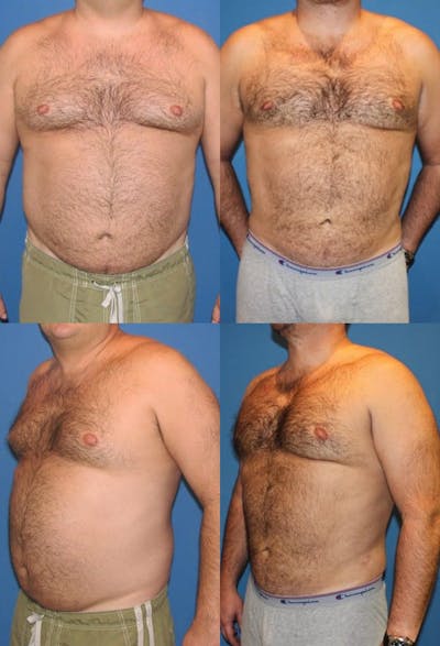 Liposuction Male Before & After Gallery - Patient 2394820 - Image 1