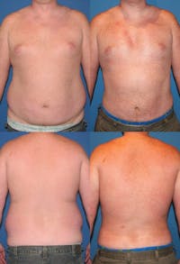 Liposuction Before & After Gallery - Patient 2159012 - Image 1