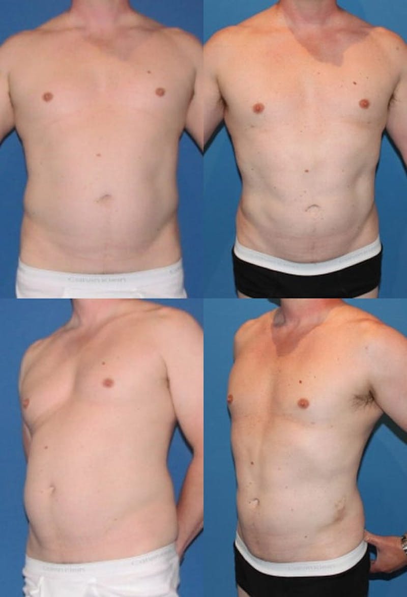 Liposuction Male Gallery - Patient 2394822 - Image 1