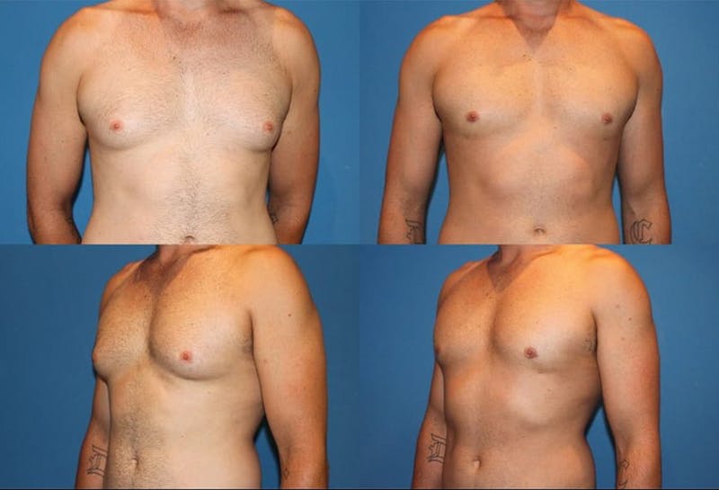 Liposuction Before & After Gallery - Patient 2159014 - Image 1