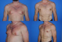 Liposuction Before & After Gallery - Patient 2159015 - Image 1