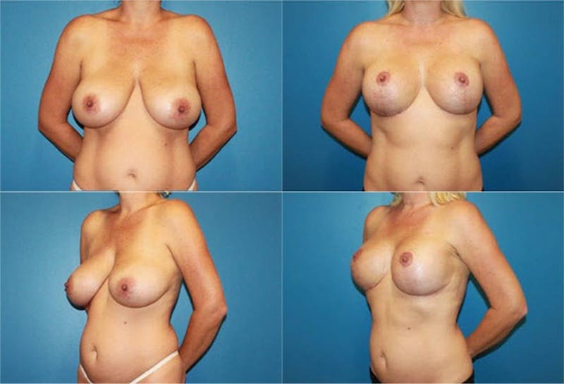 Breast Reduction