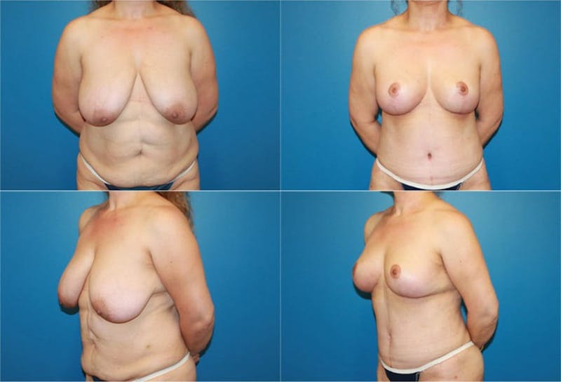 Breast Reduction