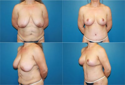 Breast Reduction Before & After Gallery - Patient 2161477 - Image 1