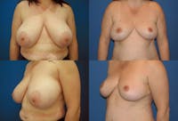 Breast Reduction Before & After Gallery - Patient 2161480 - Image 1
