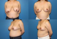 Breast Reduction Before & After Gallery - Patient 2161488 - Image 1