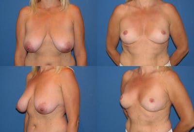 Breast Reduction Before & After Gallery - Patient 2161494 - Image 1