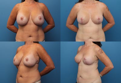 Reductive Augmentation of the Breast Before & After Gallery - Patient 2161510 - Image 1