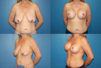 Reductive Augmentation of the Breast Before & After Gallery - Patient 2161514 - Image 1