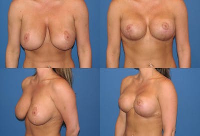 Reductive Augmentation of the Breast