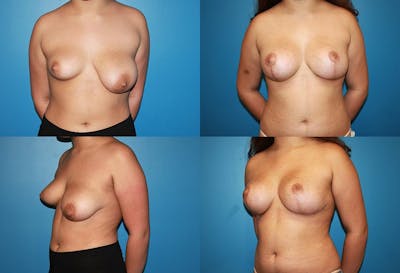 Reductive Augmentation of the Breast Before & After Gallery - Patient 2161519 - Image 1