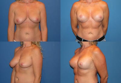 Reductive Augmentation of the Breast Before & After Gallery - Patient 2161520 - Image 1